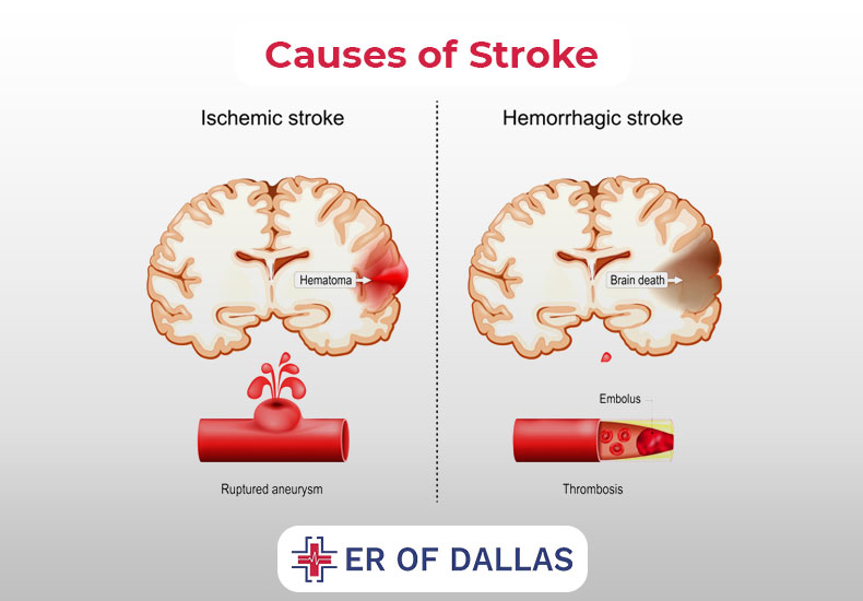 Causes of Stroke - ER of Dallas