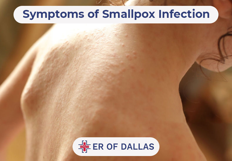Symptoms of Smallpox Infection - ER of Dallas