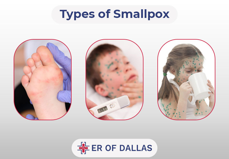 Types of Smallpox - ER of Dallas