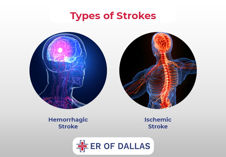 Types of Stroke - ER of Dallas