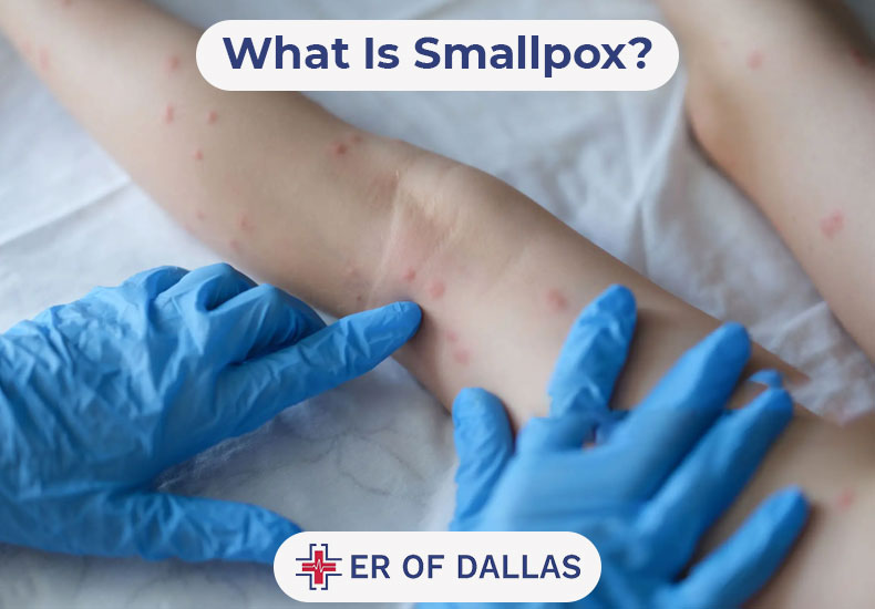 What Is Smallpox - ER of Dallas