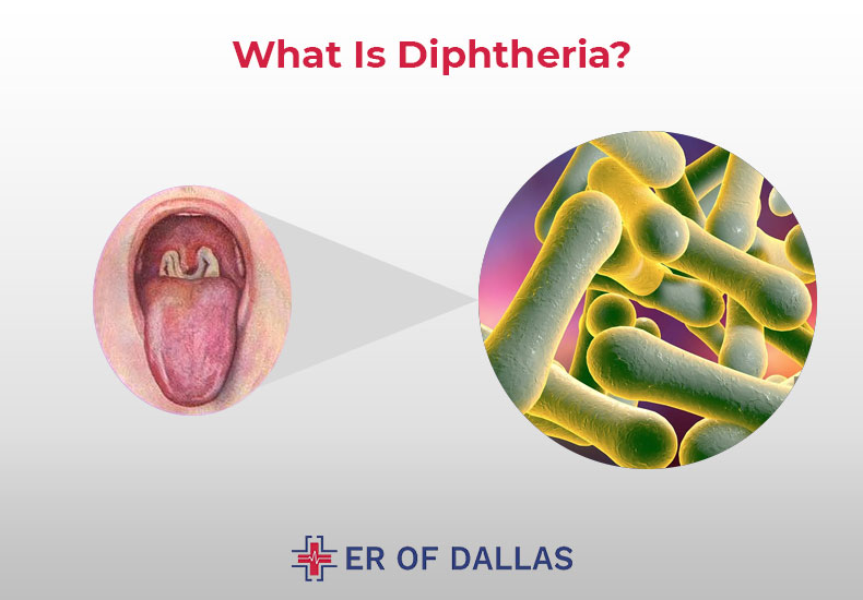 What is Diphtheria - ER of Dallas