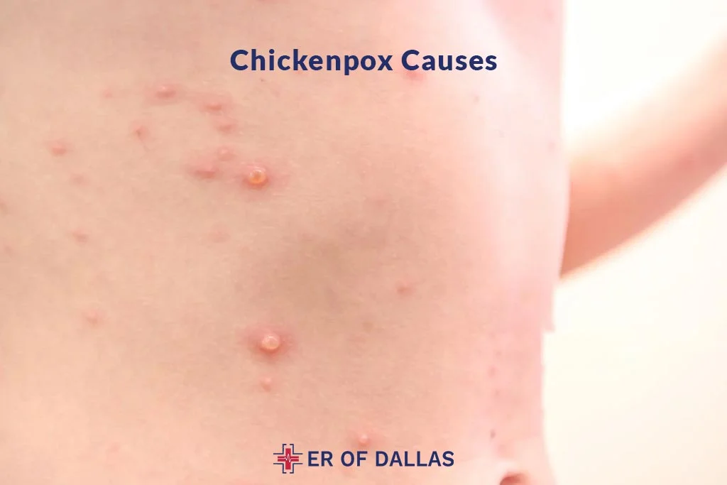 Chickenpox Causes - ER of Dallas