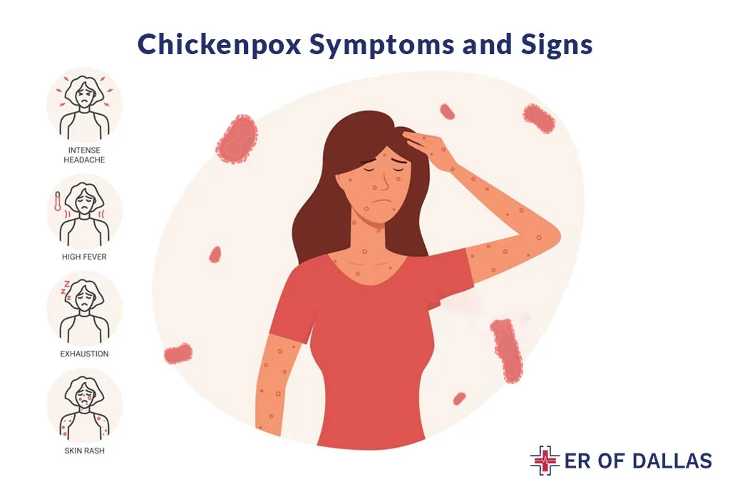 Chickenpox - Symptoms and Signs - ER of Dallas