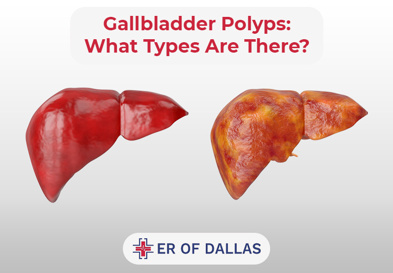 Gallbladder Polyps - What Types Are There - ER of Dallas