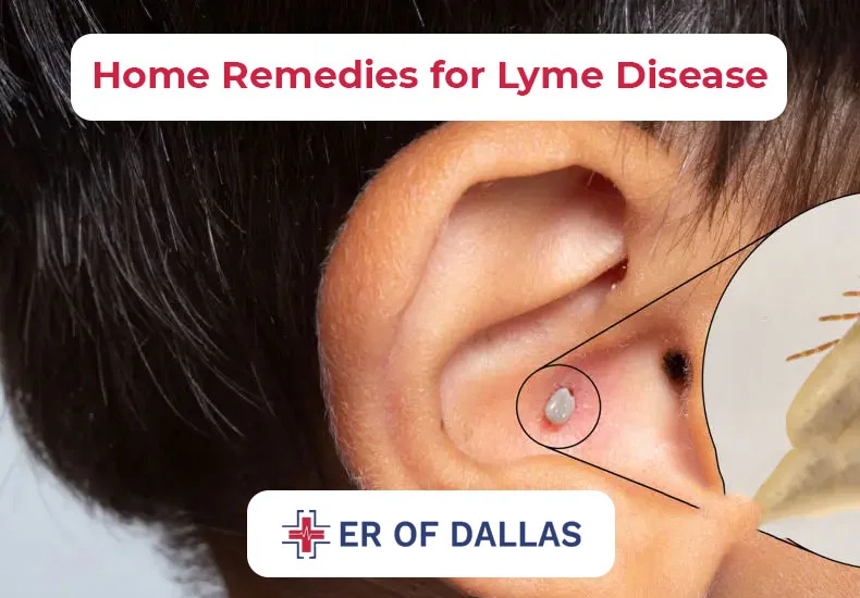 Home Remedies for Lyme Disease - ER of Dallas