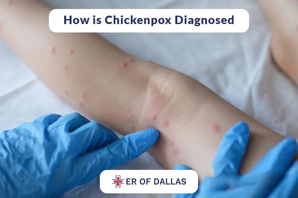 How is Chickenpox Diagnosed - ER of Dallas