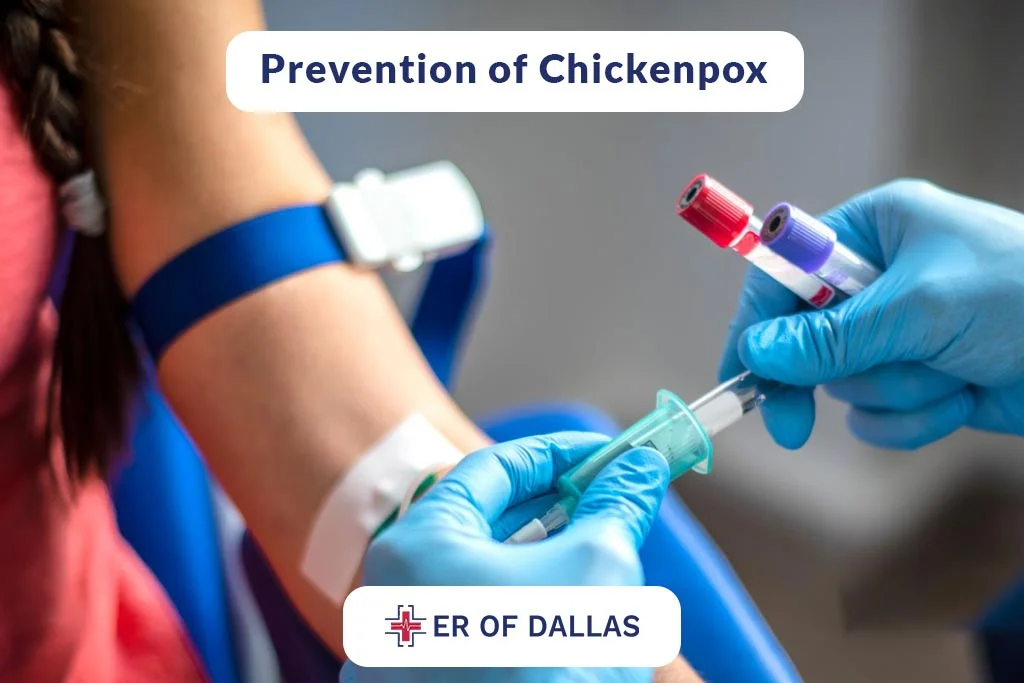 Prevention of Chickenpox - ER of Dallas