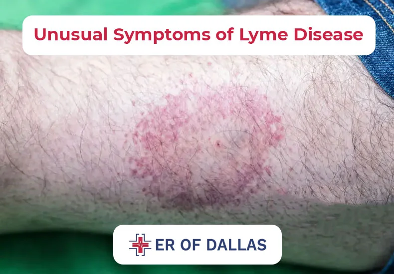 Unusual Symptoms of Lyme Disease - ER of Dallas