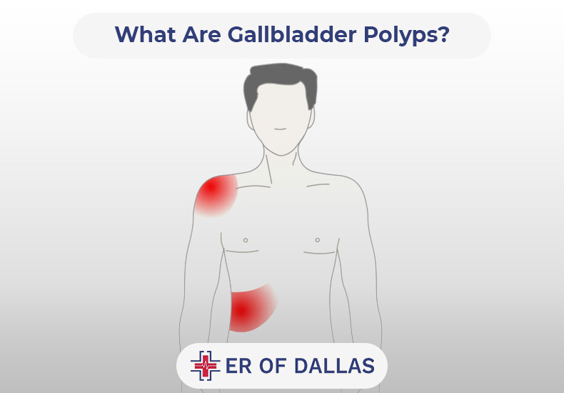 What Are Gallbladder Polyps - ER of Dallas