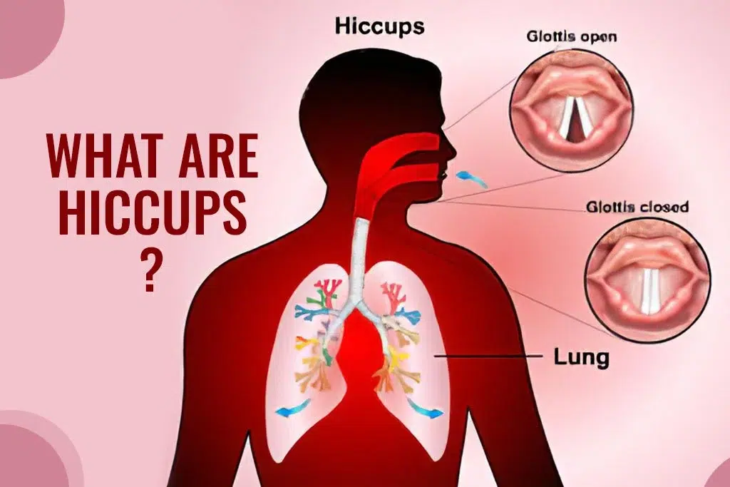 What Are Hiccups - ER of Dallas
