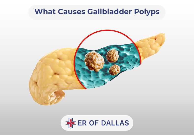 What Causes Gallbladder Polyps - ER of Dallas
