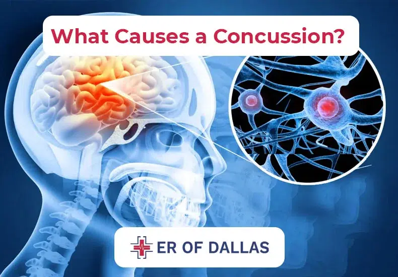 What Causes a Concussion - ER of Dallas