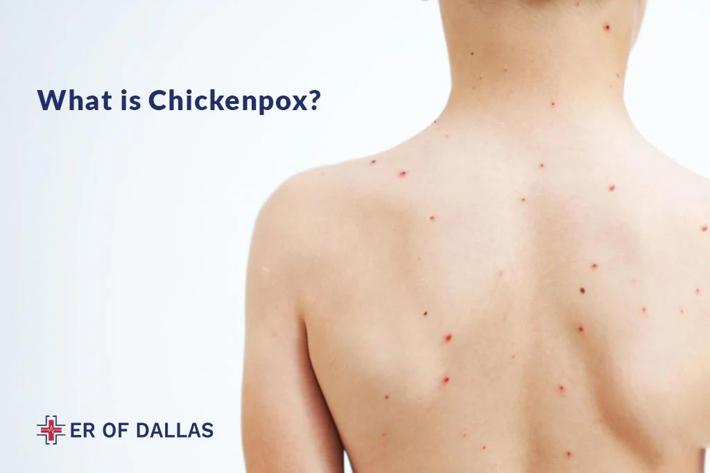 What is Chickenpox - ER of Dallas