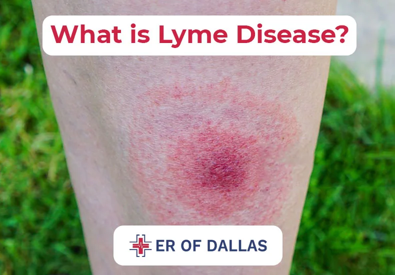 What is Lyme Disease - ER of Dallas