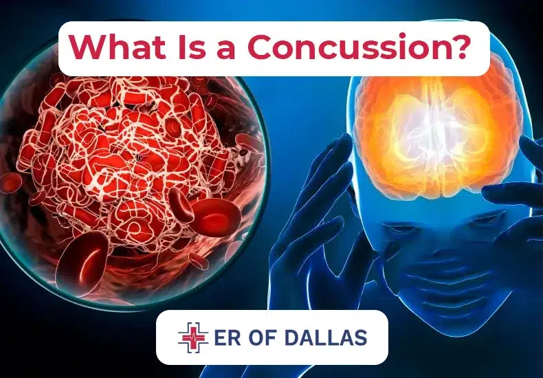 What is a Concussion - ER of Dallas