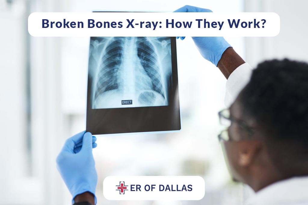 Broken Bones X-Ray - How They Work - ER of Dallas