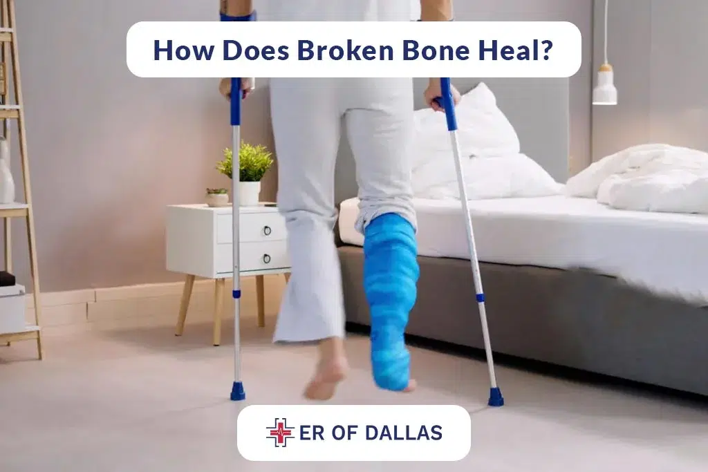 How Does Broken Bone Heal - ER of Dallas