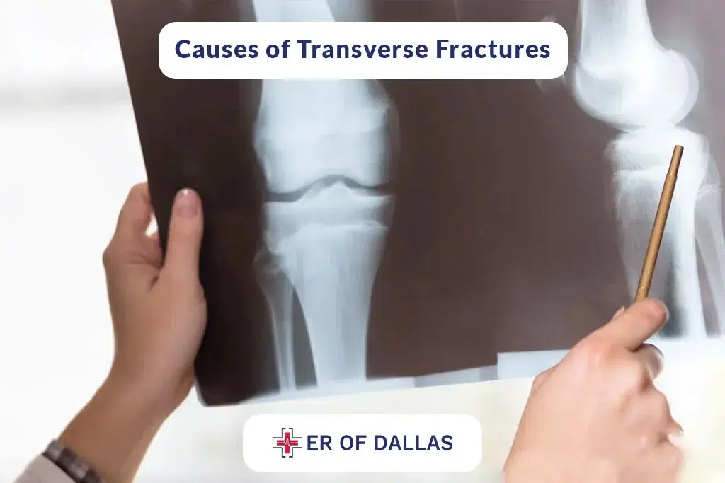 Causes of Transverse Fractures - ER of Dallas