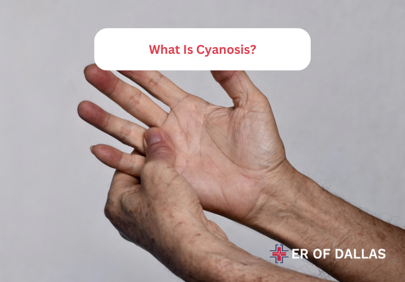 What Is Cyanosis ER of Dallas Near Me Emergency Room