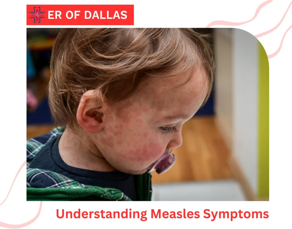 Understanding Measles Symptoms