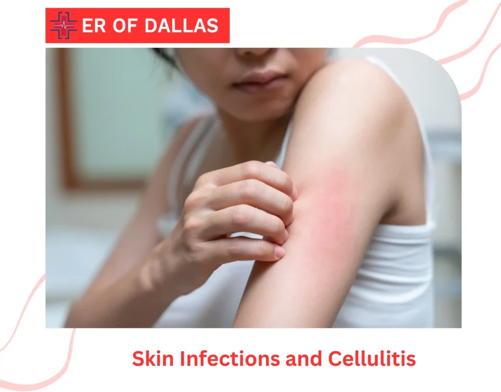 Skin Infections and Cellulitis