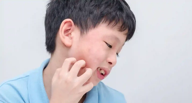 Rashes