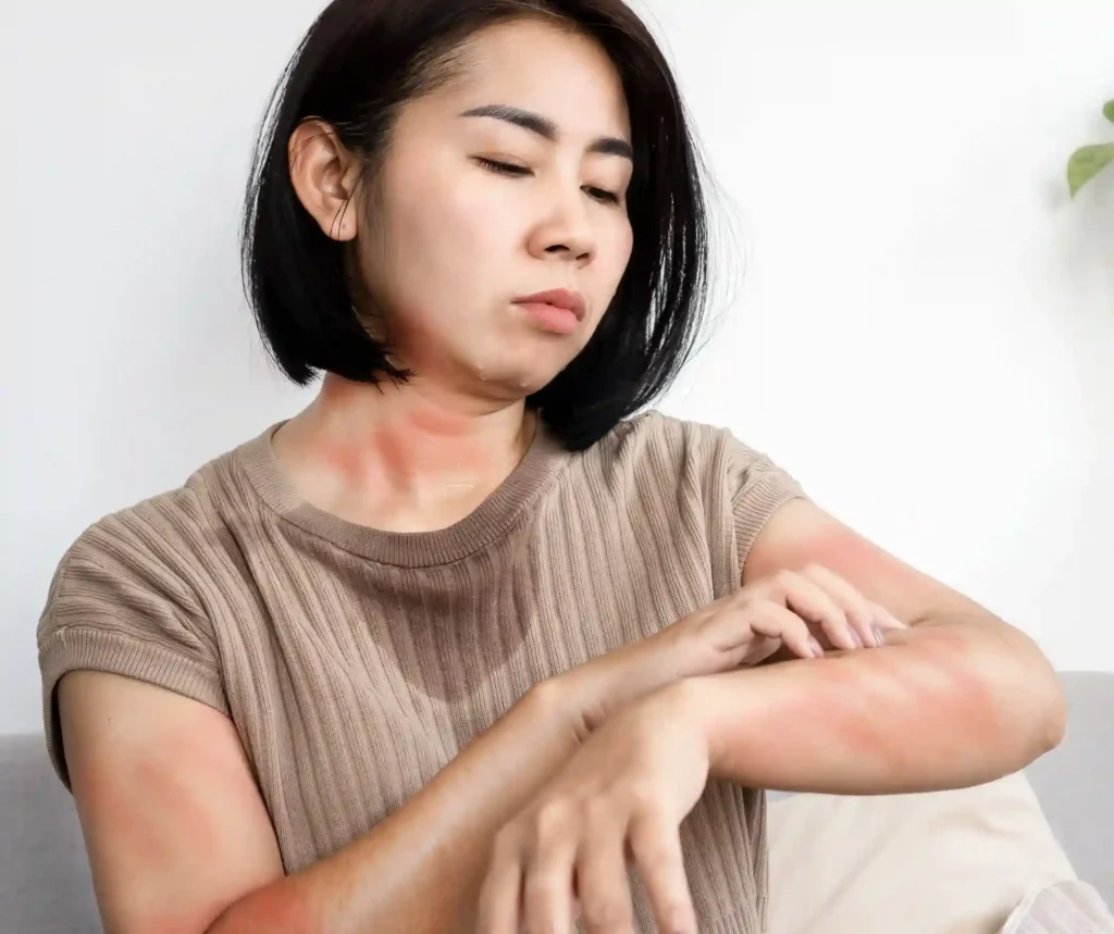 Rashes