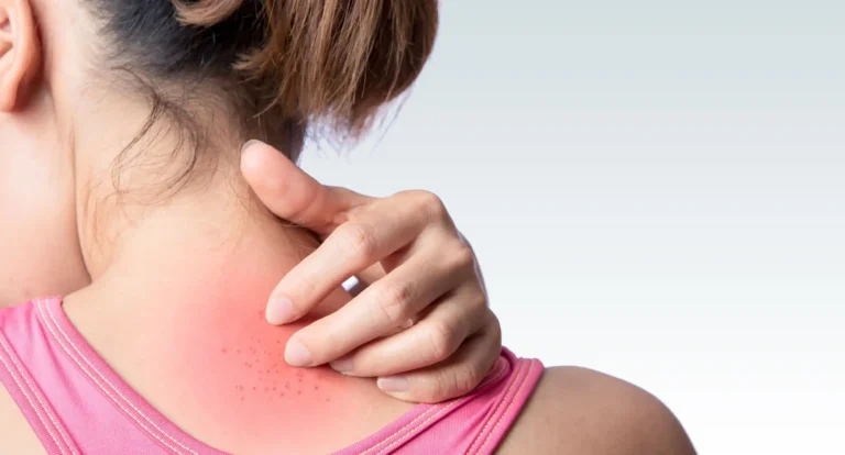 Rashes